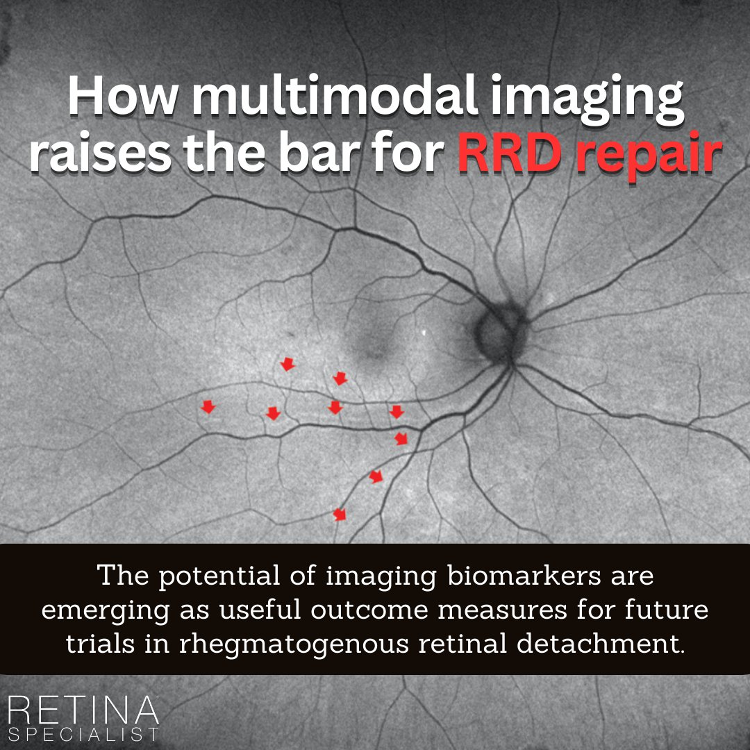 Advancements in retinal imaging tech have allowed us to gather more data and better understand the process of retinal detachment and reattachment.
Read how multimodal imaging raises the bar for RRD repair: retina-specialist.com/article/how-mu…

#retina #retinaspecialist #retinaldetachment