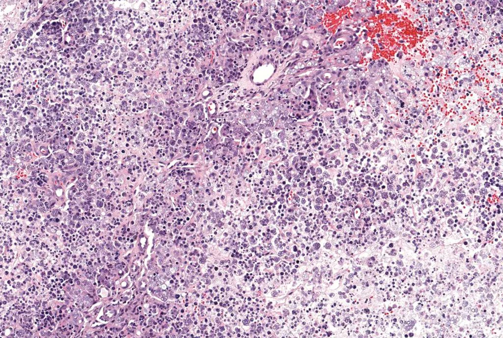 BEST example EVER of ultra-rare disease! Elderly man, hx of lymphoma, leg mass arose weeks after he cut leg on wood in garden. HE, PASD, GMS. WSI: kikoxp.com/posts/5159. Answer: kikoxp.com/posts/5155. #pathology #pathologists #pathTwitter #dermpath #dermatology #dermtwitter