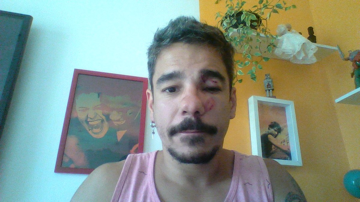 tiobeto's tweet photo. Esta imagem é uma mostra do que a homofobia é capaz, temos que denunciar este crime de ódio. Importante também compreender-se que o discurso de ódio é o que prepara o braço que agride, e em muitos casos, mata. #bastadehomofobia #homofobia https://t.co/uOfgjxHJpm