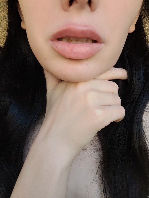 Lip filler migration is desolved in 5 days or so I can add more lip filler. https://t.co/eMPxjrAIqH<a href="/tag/newprofilepic"class="tags"><span>#newprofilepic</span></a>