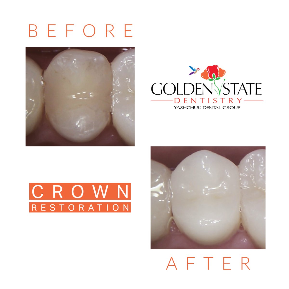 G_S_Dentistry's tweet photo. Not all #cavities are visible to the naked eye. Some cavities can form under existing restorations or between teeth, making them impossible to spot. #Dental check-ups are essential to catch any #dentalhealth problems early on.  Schedule a visit --> (925) 705-7093 #dentalcrown https://t.co/75tCZELaqC