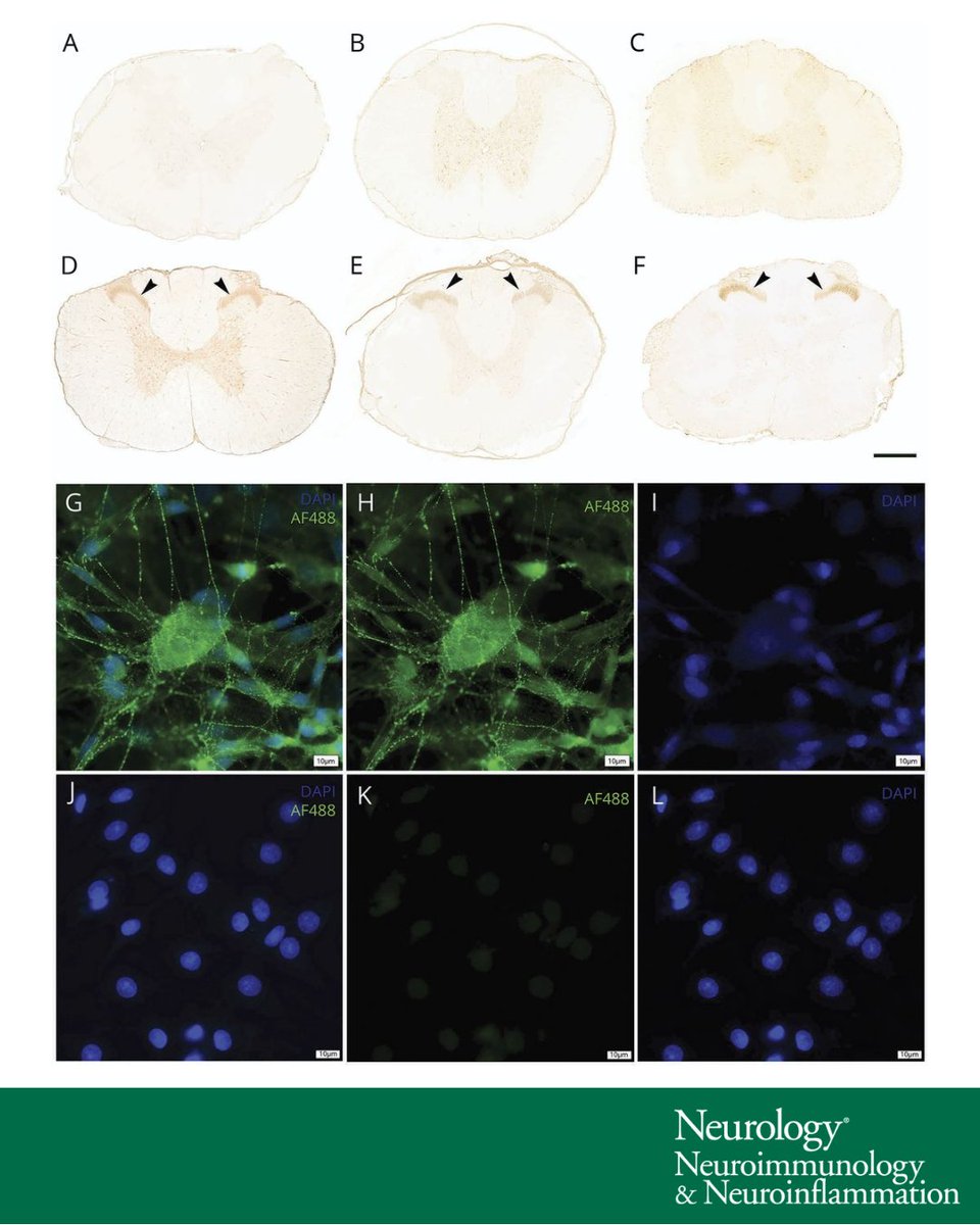 GreenJournal's tweet photo. Lesional Antibody Synthesis and Complement Deposition Associate With De Novo Antineuronal Antibody Synthesis After Spinal Cord Injury: https://t.co/GHSNJf237Y

#NeuroTwitter https://t.co/nM7jAE7YPc