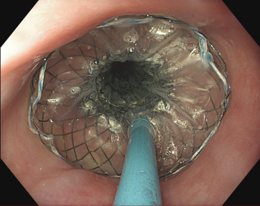 VideoGIE Journal (@videogie) on Twitter photo VideoGIE Editor's Choice: “Successful endoscopic management of a large esophageal defect due to Boerhaave syndrome with endoscopic vacuum therapy using vacuum sponge and vacuum stent” by Lisanne M.D. Pattynama et al. videogie.org/article/S2468-…
<a href="/LisannePatty/">Lisanne Pattynama</a> @RoosPouw VideoGIE Editor's Choice: “Successful endoscopic management of a large esophageal defect due to Boerhaave syndrome with endoscopic vacuum therapy using vacuum sponge and vacuum stent” by Lisanne M.D. Pattynama et al. videogie.org/article/S2468-…
<a href="/LisannePatty/">Lisanne Pattynama</a> @RoosPouw