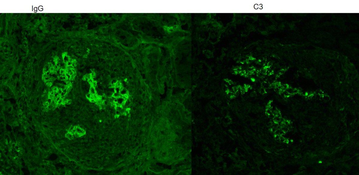 JZRenalPath's tweet photo. Older pt with AKI, hematuria, and proteinuria. Bx with essentially 100% active crescents. Some relatively low level immune complex deposition as well.  Sky high MPO positivity. ANA also positive. Guess what medication this patient was taking? #renalpath #PathTwitter https://t.co/QBlzHsV7an