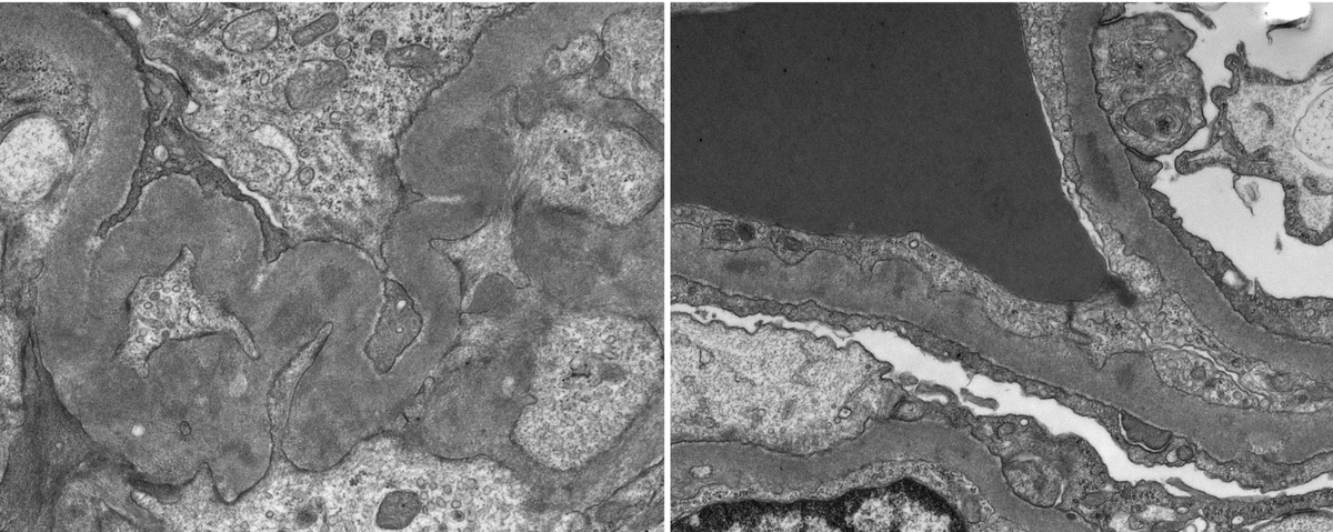 Older pt with AKI, hematuria, and proteinuria. Bx with essentially 100% active crescents. Some relatively low level immune complex deposition as well.  Sky high MPO positivity. ANA also positive. Guess what medication this patient was taking? #renalpath #PathTwitter