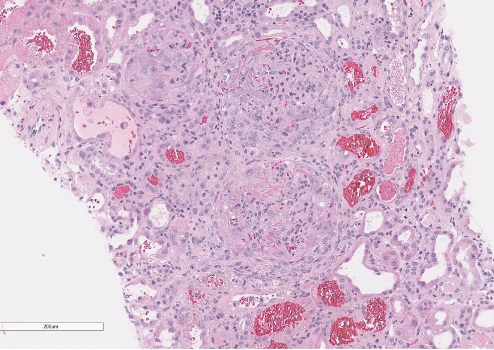 JZRenalPath's tweet photo. Older pt with AKI, hematuria, and proteinuria. Bx with essentially 100% active crescents. Some relatively low level immune complex deposition as well.  Sky high MPO positivity. ANA also positive. Guess what medication this patient was taking? #renalpath #PathTwitter https://t.co/QBlzHsV7an