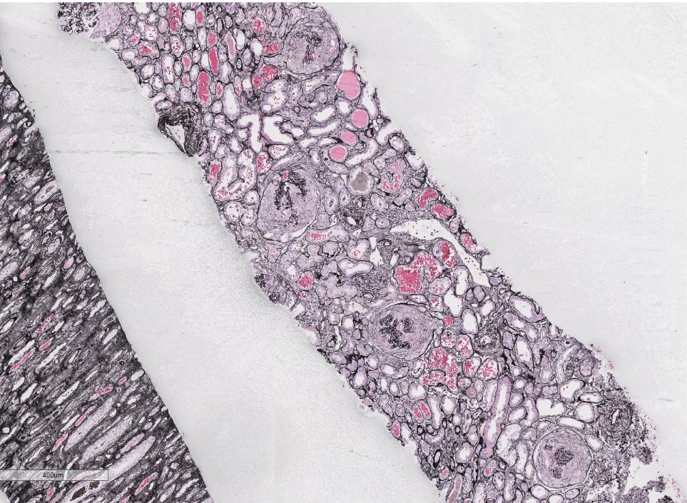 JZRenalPath's tweet photo. Older pt with AKI, hematuria, and proteinuria. Bx with essentially 100% active crescents. Some relatively low level immune complex deposition as well.  Sky high MPO positivity. ANA also positive. Guess what medication this patient was taking? #renalpath #PathTwitter https://t.co/QBlzHsV7an