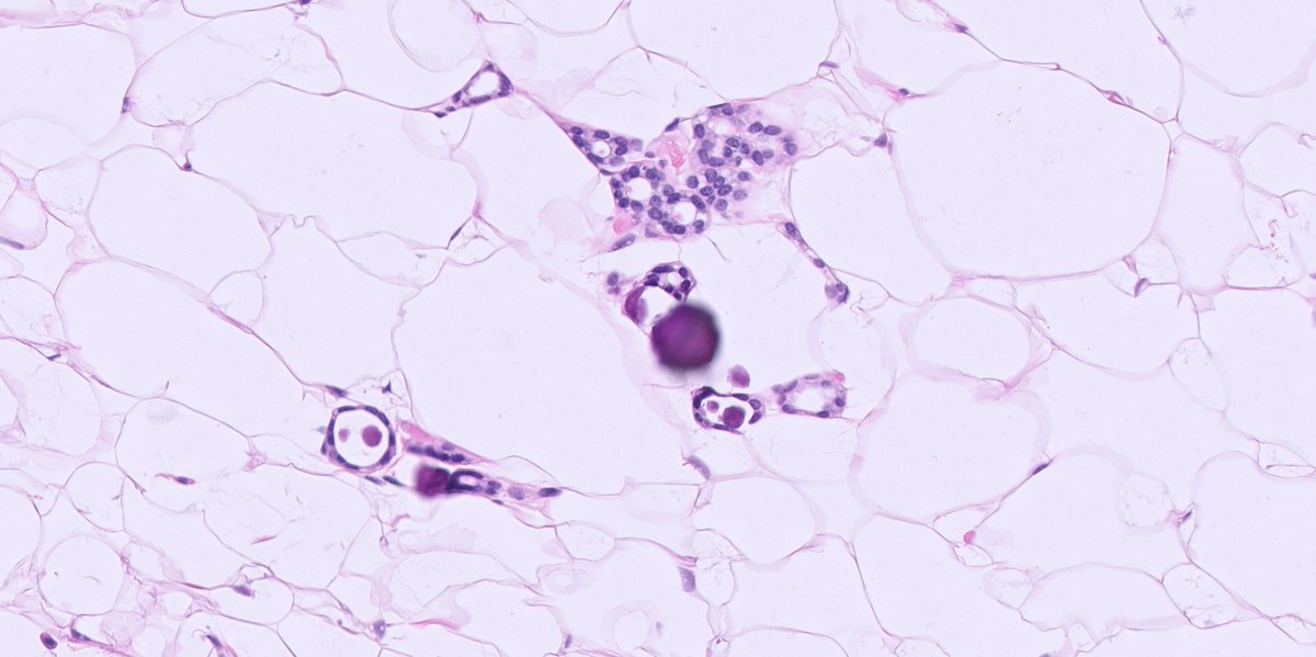 kis_lorand's tweet photo. 1/ Cluster of glands with microcalcifications in a breast excision after neoadjuvant therapy ππ
What are your thoughts #Pathtwitter?
#breastpath #pathology https://t.co/JJdmVKfs5j