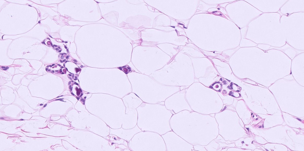kis_lorand's tweet photo. 1/ Cluster of glands with microcalcifications in a breast excision after neoadjuvant therapy ππ
What are your thoughts #Pathtwitter?
#breastpath #pathology https://t.co/JJdmVKfs5j
