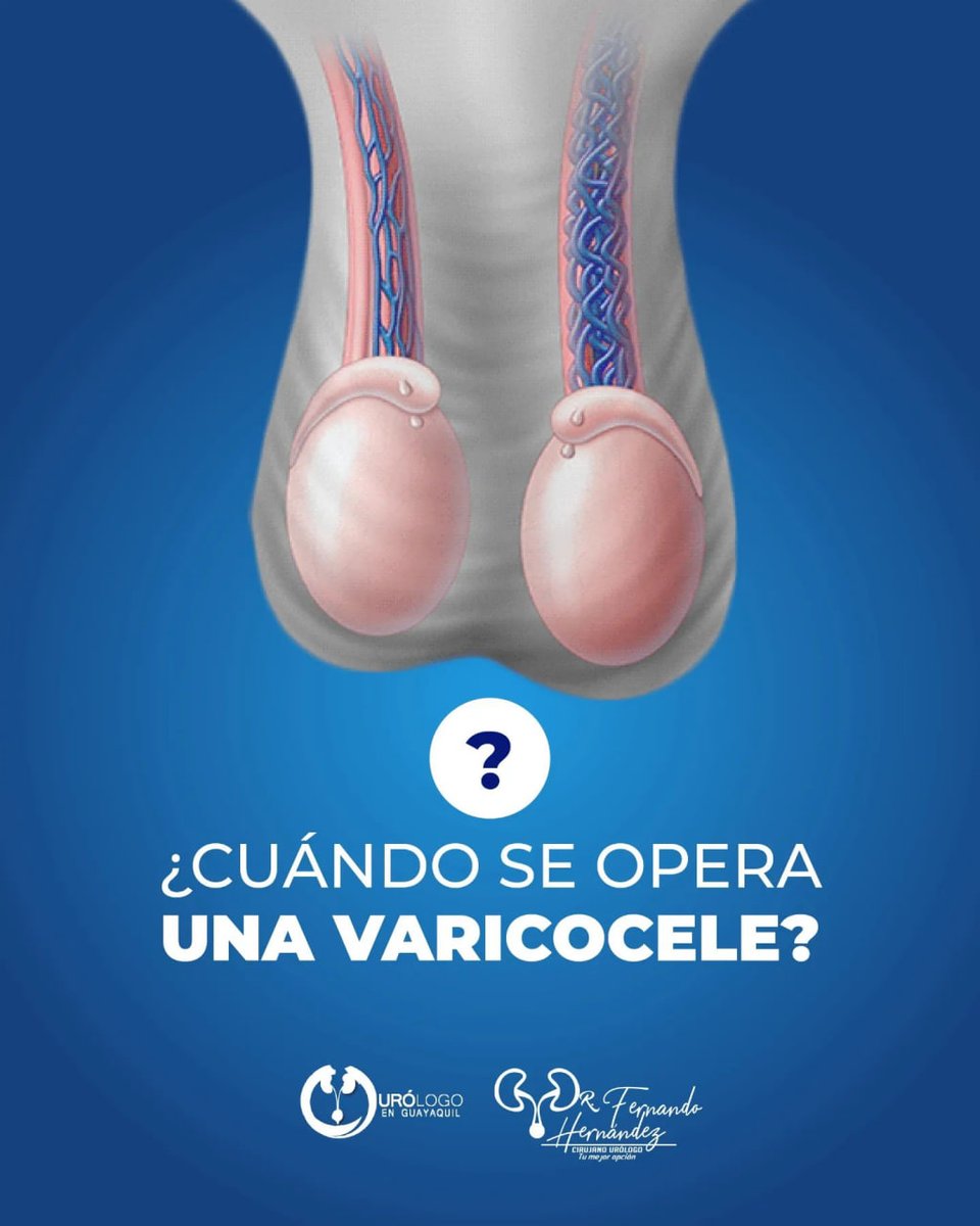 urologofernando's tweet photo. La cirugía de varicocele se indica cuando existe un varicocele que se palpa en el examen físico del paciente. A esto, se debe sumar también un espermiograma alterado.👨🏻‍⚕️ 

Así, si ambas condiciones están presentes en un hombre, se opera.👁️👁️ https://t.co/aLaBmTRZiH
