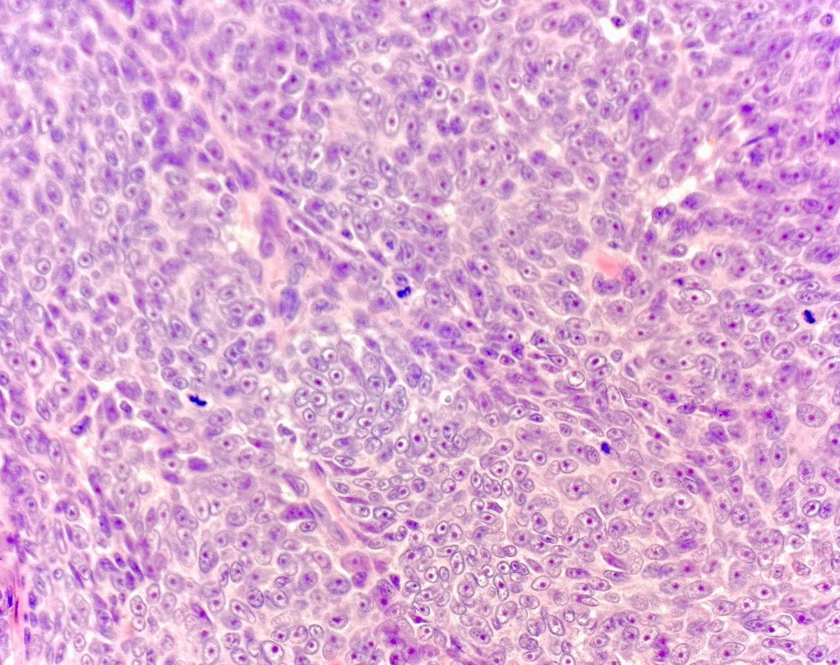 MBBS_Pathology's tweet photo. Malignant intruder.
#Melanoma surrounding + colonising a #naevus
📸 1 Intruder + naevus
📸 2 Intruder solo
📸 3 Naevus solo
💙💛
#dermatology
#pathology
#dermpath https://t.co/37ovHtn5JQ