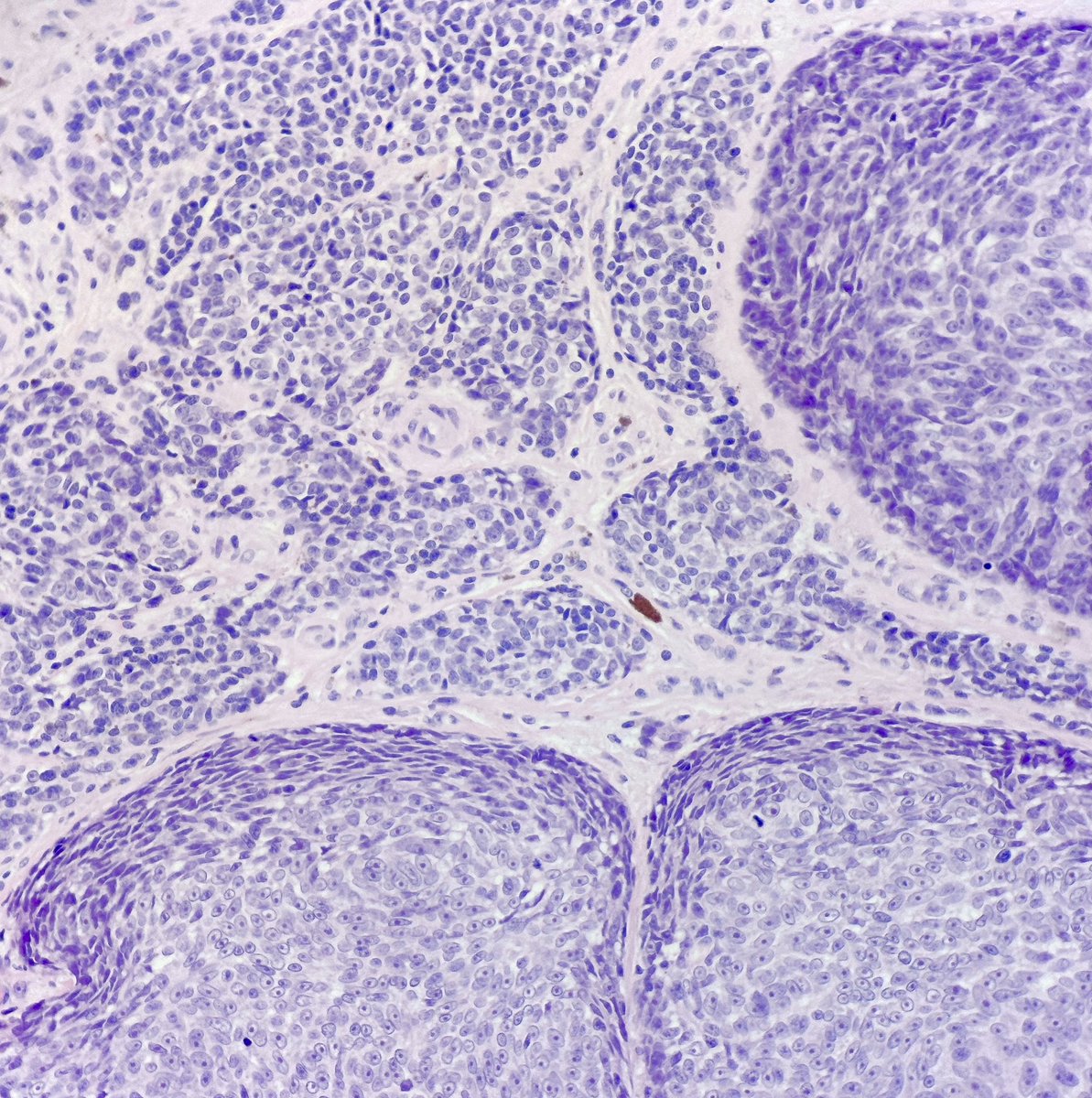 MBBS_Pathology's tweet photo. Malignant intruder.
#Melanoma surrounding + colonising a #naevus
📸 1 Intruder + naevus
📸 2 Intruder solo
📸 3 Naevus solo
💙💛
#dermatology
#pathology
#dermpath https://t.co/37ovHtn5JQ