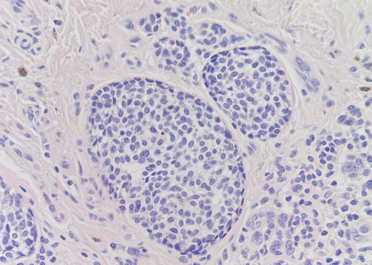 MBBS_Pathology's tweet photo. Malignant intruder.
#Melanoma surrounding + colonising a #naevus
📸 1 Intruder + naevus
📸 2 Intruder solo
📸 3 Naevus solo
💙💛
#dermatology
#pathology
#dermpath https://t.co/37ovHtn5JQ