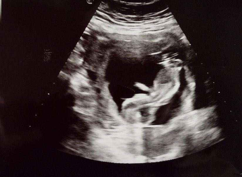 The_Imago_Dei's tweet photo. 🥰 Thank you Lord! Due date 10/23/23 

#babysave #voiceforthevoiceless #ministry https://t.co/7lEoxbvCVg