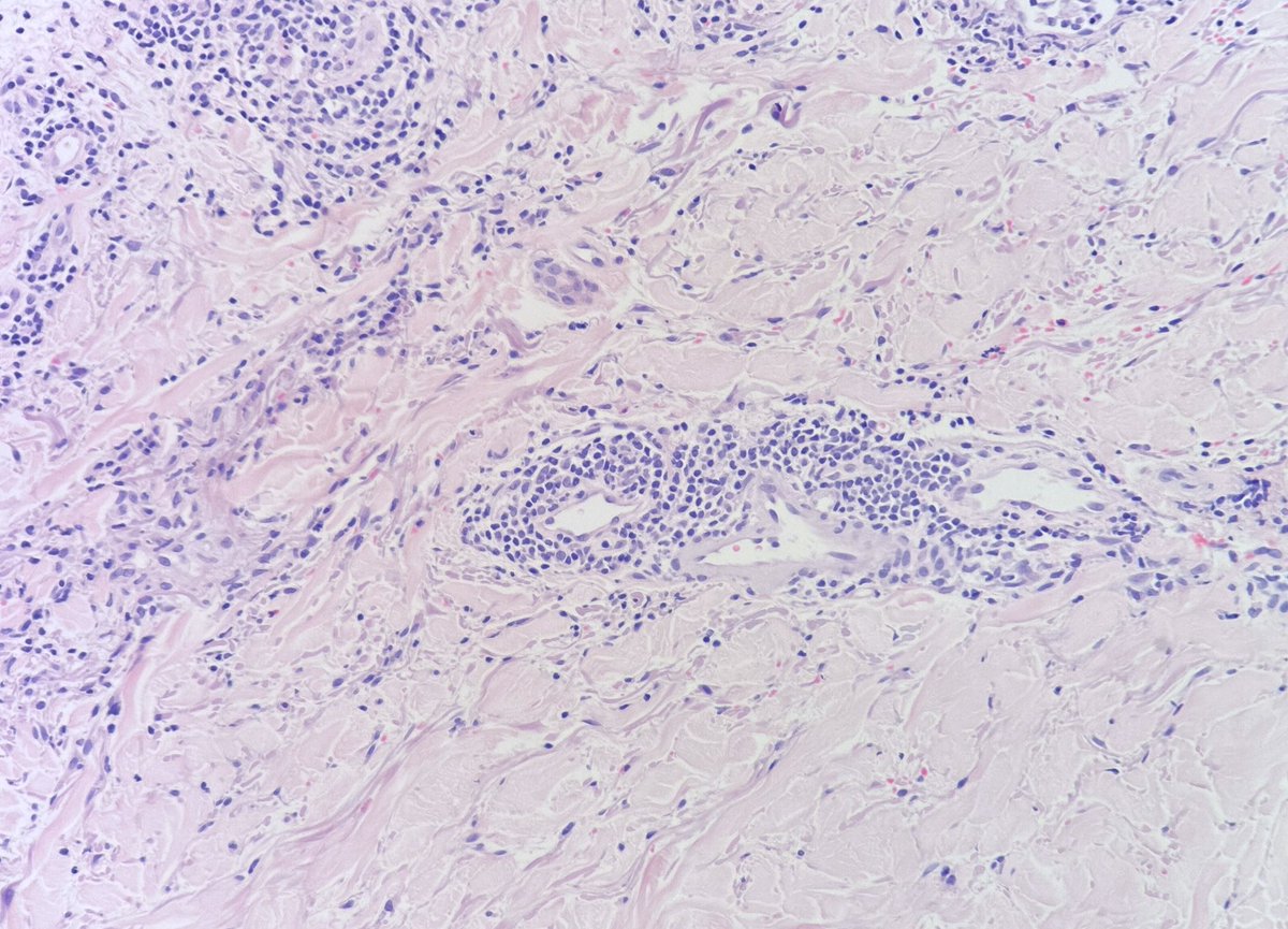 MBBS_Pathology's tweet photo. The ☀️ was shining here today. Not always blue sky news 😢
#PolymorphicLightEruption
🔬Dramatic subepidermal oedema
🔬Superficial + Deep perivascular lymphocytes
💛💙
#dermatology
#pathology
#dermpath https://t.co/We4Nemj9OF