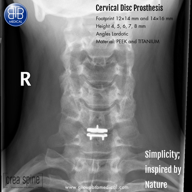 btbmedical's tweet photo. Cervical Disc Prosthesis
https://t.co/pSnar4F4nb
INNOVATIVE SOLUTIONS
#Neurotechnology #neurosurgery #spinalneurosurgery #spinalproducts #hip #arthroplasty #hipproducts #trauma #traumaproducts #surgery #surgicalinstruments #titanium #innovation #heath #groupbtb #btbmedical https://t.co/iL0PdjSVBM