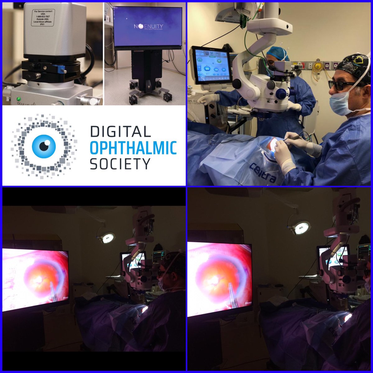 Memories since APRIL 1st, 2019 !!!

The NGENUITY® 3D , my first trial.

#Ngenuity #ngenuity3d #alcon #digitalophthalmicsociety  

@DigitalOphtho <a href="/ASCRStweets/">ASCRS</a> <a href="/CRSToday/">Cataract & Refractive Surgery Today</a> <a href="/TrukeraMedical/">Trukera Medical</a>  @RaynerIOL <a href="/TraceyTechCorp/">Tracey Technologies</a> <a href="/Alcon/">Alcon Revival</a>
