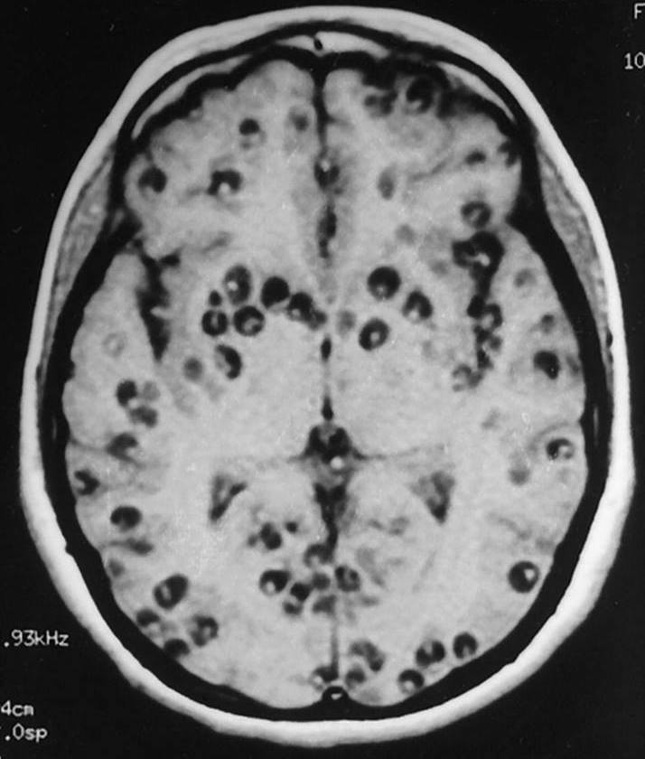 EnsedeCiencia's tweet photo. Esta Imagen por resonancia es de un paciente que se está muriendo debido a una cisticercosis cerebral, una de las enfermedades más aterradoras que existen. Nótese la gran cantidad de larvas en la masa encefálica.

La neurocisticercosis es una enfermedad producida por larvas de Taenia solium, las cuales se desarrollan en cualquier parte del sistema nervioso central (hablando específicamente de neurocisticercosis). Para que se produzca la enfermedad, un humano tendría que consumir alimentos contaminados con huevos de dicho platelminto.

Esta aseveración contradice aquella creencia popular de que con comer carne de cerdo con cisticercos, puedes contraer esta enfermedad parasitaria.