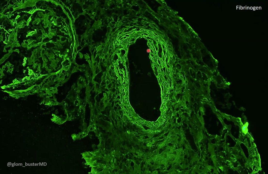 MCW_Nephrology's tweet image. #Nephropath @glom_busterMD discusses an interesting case of pauci-immune GN with prominent necrotizing arteritis.
#MedEd