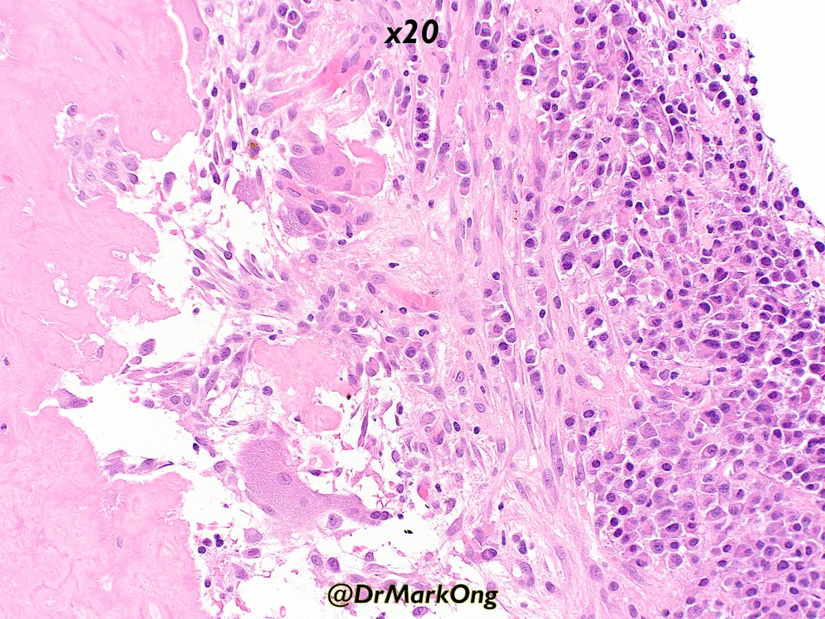 Biopsy of vertebral mass.

What's your diagnosis #pathtwitter?