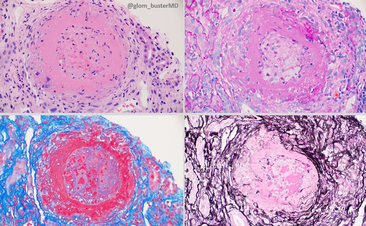 MCW_Nephrology's tweet image. #Nephropath @glom_busterMD discusses an interesting case of pauci-immune GN with prominent necrotizing arteritis.
#MedEd