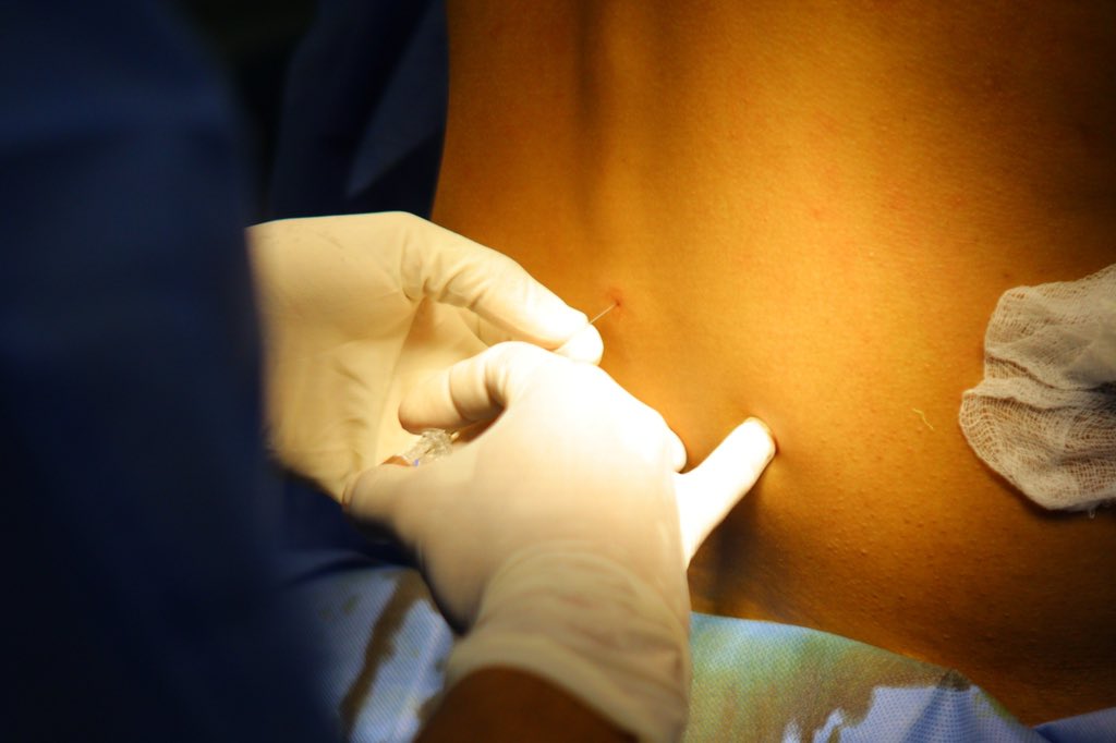 FreddyBernal's tweet image. ¡En #Táchira seguimos consolidando la Planificación Familiar!  Gracias a las alianzas que realiza la Gobernación del estado Táchira a través de la Fundación de la Familia Tachirense, realizamos una jornada gratuita de esterilizaciones para nuestras mujeres en el CDI Hugo Murzi en…