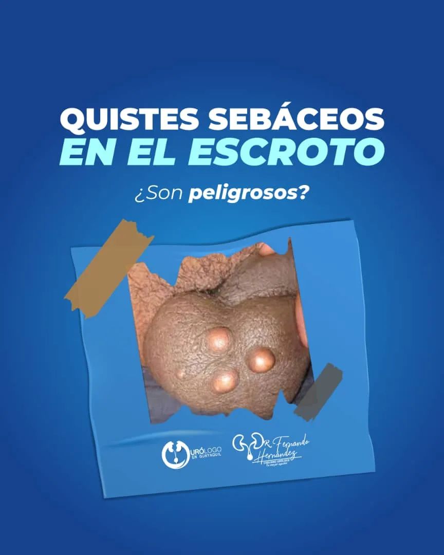 urologofernando's tweet photo. 👀Un quiste sebáceo es un pequeño bulto redondeado que puede aparecer en la superficie de la piel de cualquier parte del cuerpo. 

Es frecuente que salgan en el área genital, especialmente en el escroto, pero también pueden aparecer en el tallo del pene. https://t.co/cYLvSduOH8