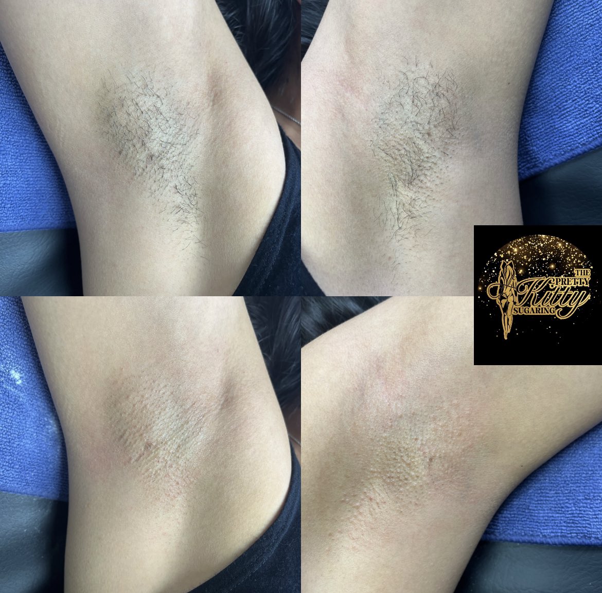 Thepk_sugaring's tweet photo. Get your underarms sugared this summer ☀️👙🥳🤗 https://t.co/sLfFcnQJ9E