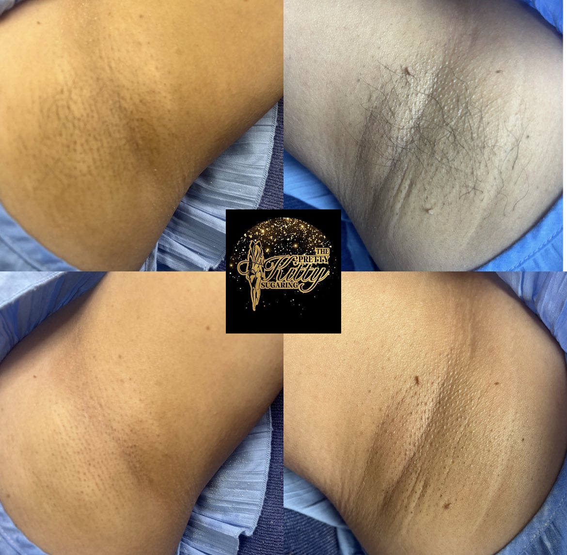 Thepk_sugaring's tweet photo. Get your underarms sugared this summer ☀️👙🥳🤗 https://t.co/sLfFcnQJ9E