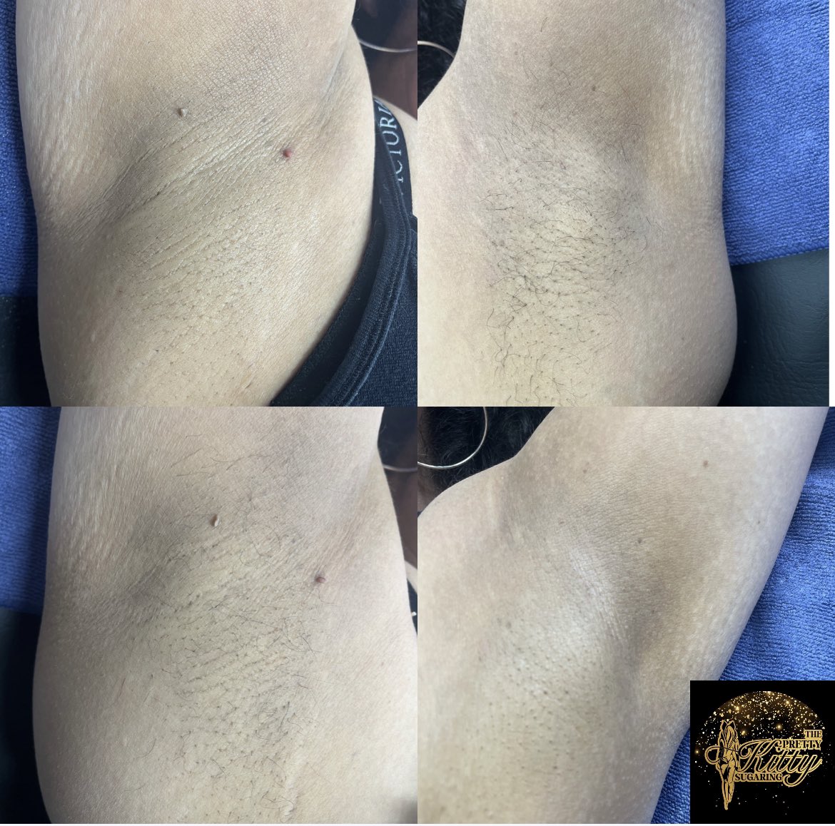 Thepk_sugaring's tweet photo. Get your underarms sugared this summer ☀️👙🥳🤗 https://t.co/sLfFcnQJ9E
