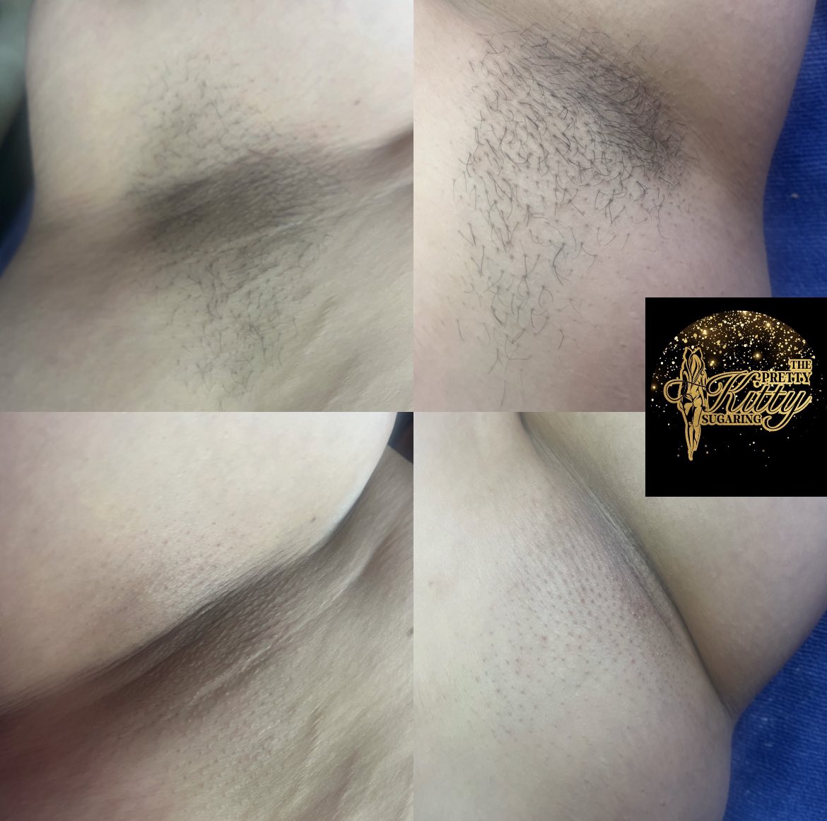 Thepk_sugaring's tweet photo. Get your underarms sugared this summer ☀️👙🥳🤗 https://t.co/sLfFcnQJ9E