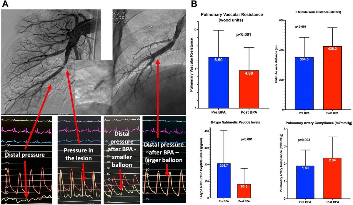 American College of Cardiology (@accintouch) on Twitter photo Q: What is the safety & efficacy of balloon pulmonary angioplasty for chronic thromboembolic pulmonary hypertension?
A: Balloon pulmonary angioplasty is safe & effective in patients with chronic thromboembolic pulmonary hypertension.
bit.ly/41BU97j #JACCAdvances Q: What is the safety & efficacy of balloon pulmonary angioplasty for chronic thromboembolic pulmonary hypertension?
A: Balloon pulmonary angioplasty is safe & effective in patients with chronic thromboembolic pulmonary hypertension.
bit.ly/41BU97j #JACCAdvances
