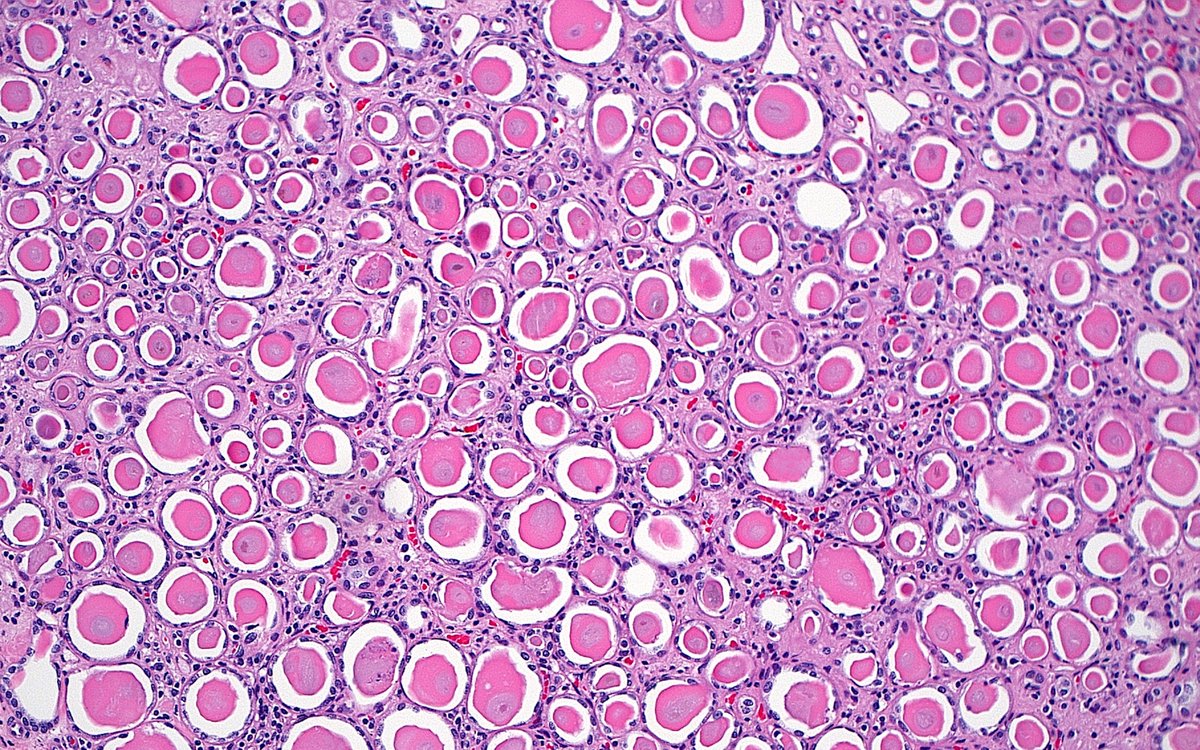 Thyroid? Actually, thyroidization.  
#PathArt  #RenalPath