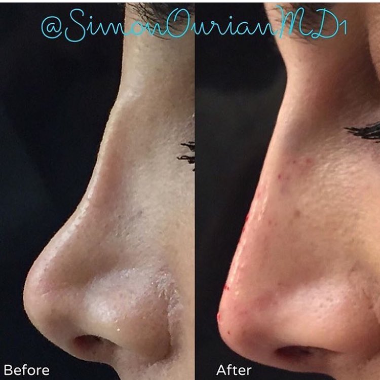 simonourianmd's tweet photo. Non-Surgical Nose Job
#nosejob #nosugery #nonsurgical #noselift #nosefiller #fillers #transformation #makeover #simonourian #epione https://t.co/FZp4rIHaQ5