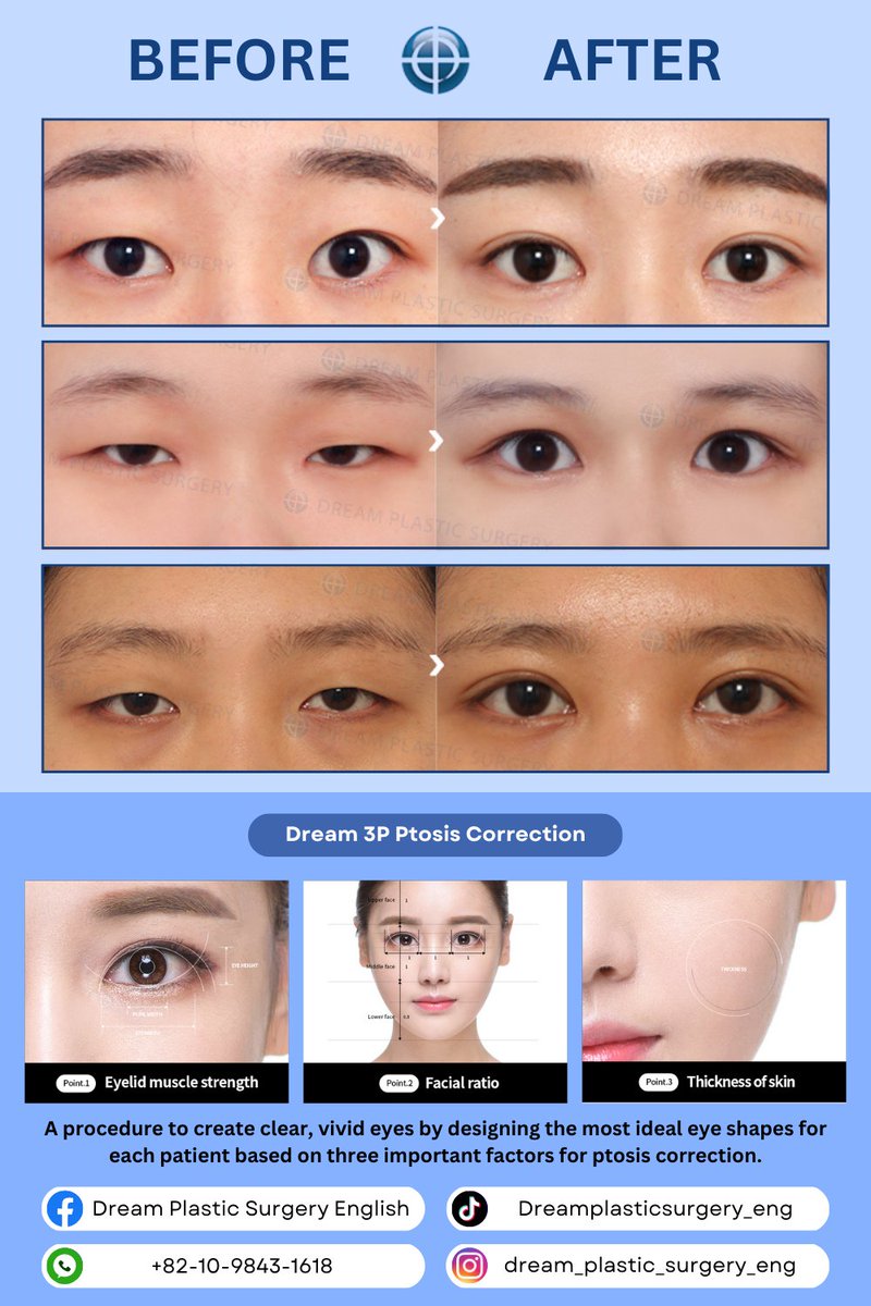dreamprs_eng's tweet photo. #plasticsurgery #dreamplasticsurgery #rhinoplasty #nosejob #nosesurgerys #koreanplasticsurgery #koreaplasticsurgeryreview #beforeandafter #koreaplasticsurgerybeforeandafter #surgerybeforeandafter #beforeandafterchallenge #prettygirls #doubleeyelid #eyemakeup #dreamsurgery #eyelid https://t.co/RHciuf7TmN