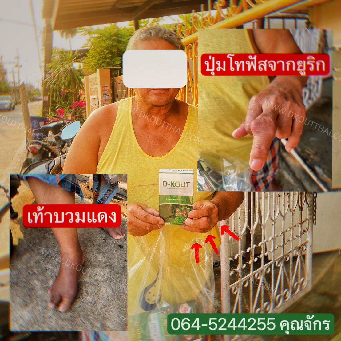 dkoutthai's tweet photo. อาการของโรคเก๊าต์ เป็นแล้วอันตรายกว่าที่คิด อาจเกิดภาวะไตวายได้
สั่งซื้อคลิก https://t.co/koNQXECfol…ติดตามต่อได้ที่ https://t.co/kKSyZHllVf
#เก๊าต์ #เก๊าท์ #เก๊า  #กรดยูริก #บำรุงไต #ดีเก๊าท์คุณจักร #ตงตงเบส #แน็กชาลี #ค่าไฟ #MissGrandThailand2023 #น้ําเพชร #ไทยรัฐดีเบต https://t.co/OcLUb2NXC7