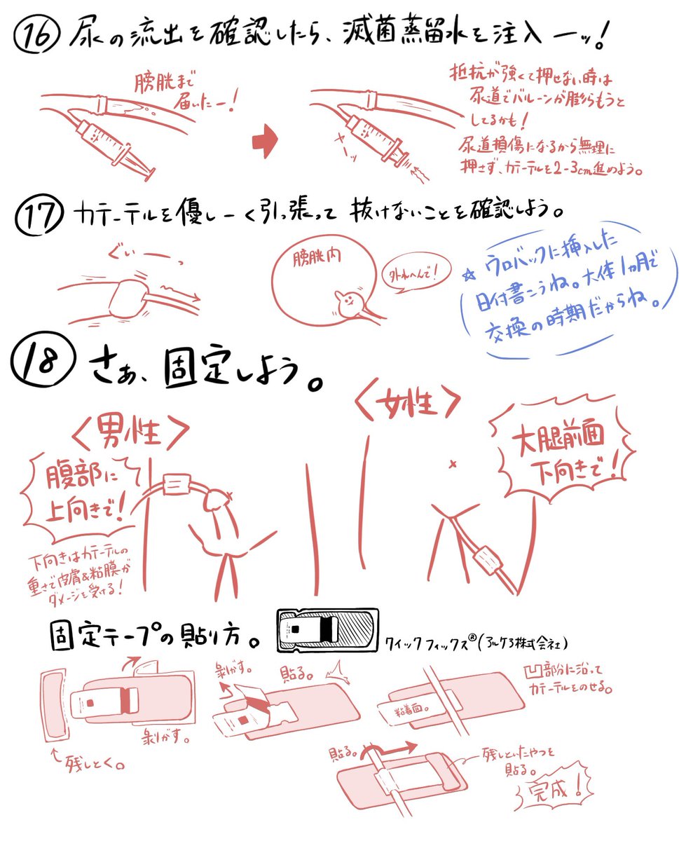 膀胱留置カテーテル挿入の手順(2/2) 