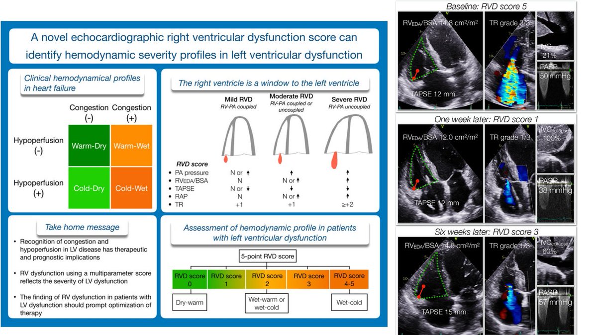 A novel #echofirst right ventricular dysfunction score can identify hemodynamic severity profiles in left ventricular dysfunction 🧐
🔗…ovascularultrasound.biomedcentral.com/articles/10.11…
#POCUS #MedEd #IMPOCUS