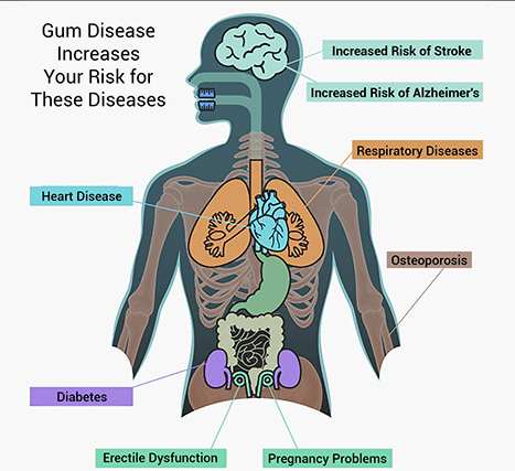 gorka_orive's tweet photo. La importancia de la higiene oral.
Un mayor número de evidencias asocian la enfermedad periodontal con un conjunto de enfermedades como la diabetes, enfermedades cardíacas, infecciones respiratorias e incluso demencia. https://t.co/2I80GuGFz5 https://t.co/Av4DXlC95U