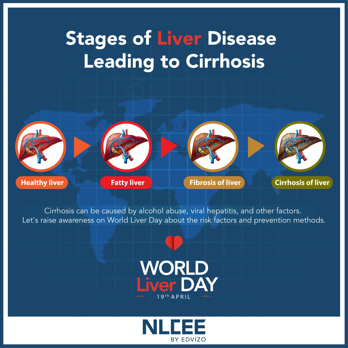 edvizo's tweet photo. Cirrhosis is a serious liver condition that occurs when the liver is damaged and scarred over time. Limit alcohol consumption, get vaccinated, and maintain a healthy weight to prevent Cirrhosis.

#worldliverday2023 #worldliverday #liver #cirrhosis
#edvizo https://t.co/jLuy2Ij1vv