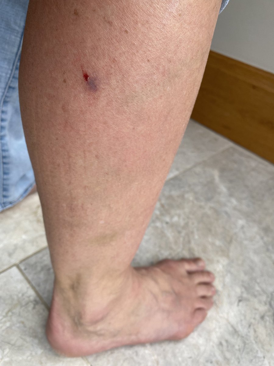 If you doubt for even one hot second that your precious dog couldn’t possibly ever ever bite someone then PUT IT ON A LEAD #trailrunning #oxshottheath #RBR #elmbridge