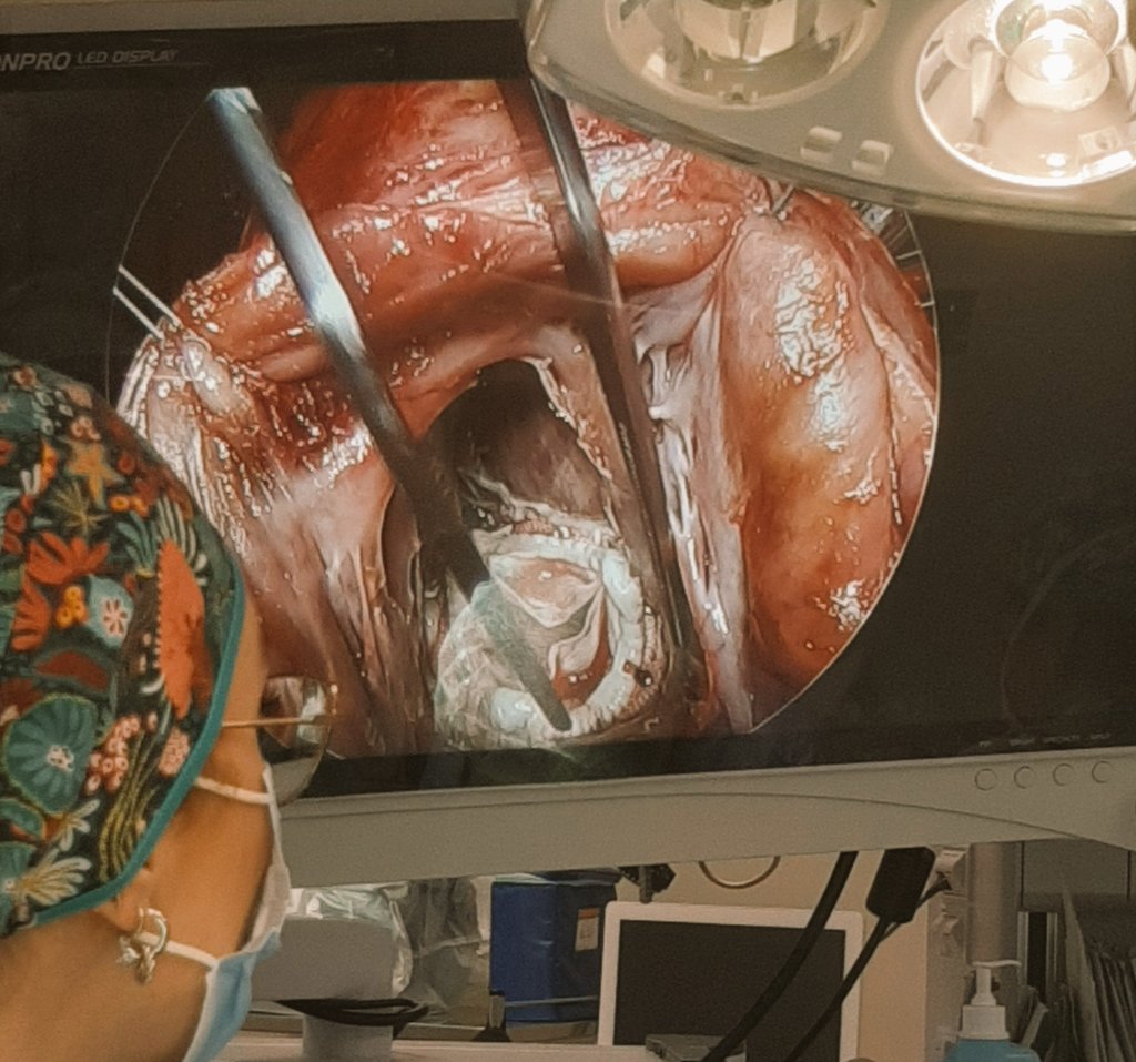 Cardiac Surgery Gregorio Marañon Hospital tweet media