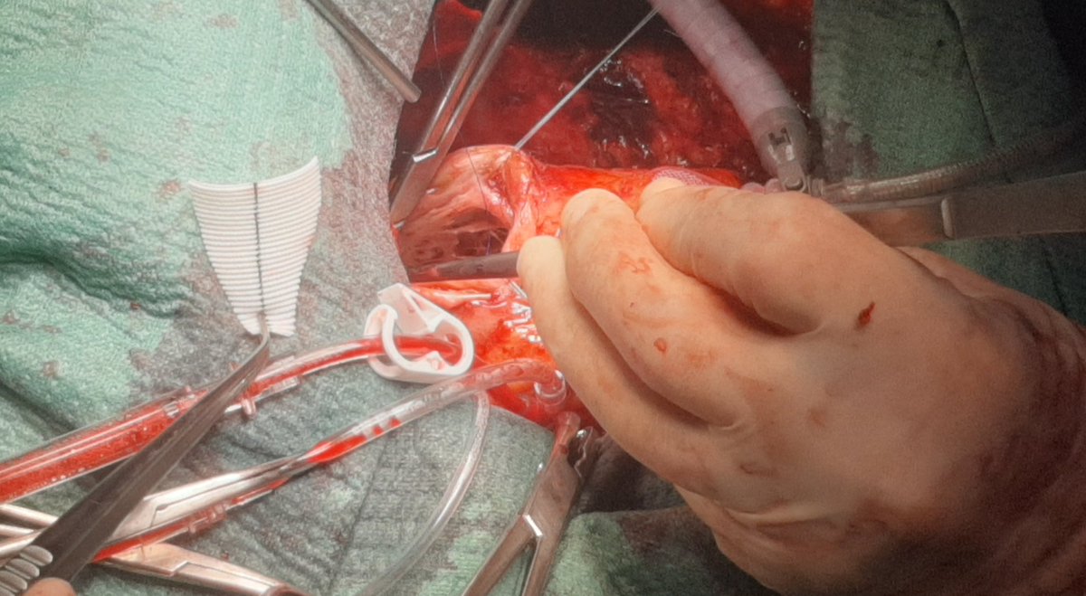 Cardiac Surgery Gregorio Marañon Hospital tweet media