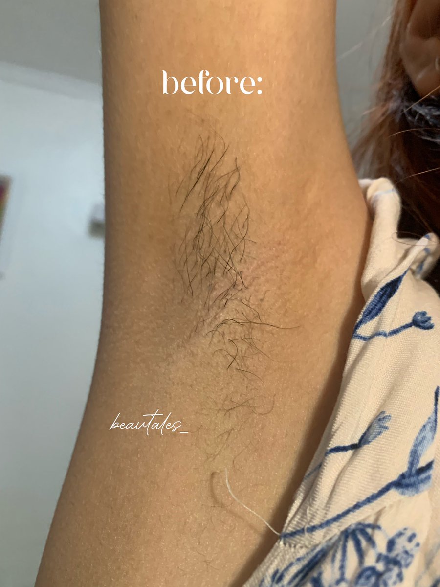 beautales_'s tweet photo. ⚠️ TW // KETIAK

*✰ setelah dua tahun rajin wax, aku ngerasa pertumbuhan bulu aku lebih lambat, ini bulu aku setelah ga waxing dua bulanan lebih padahal aku tergolong super hairy

heres a tutorial (+ tips) waxing buat beginner! ❤️ https://t.co/cXjsHNiPPg