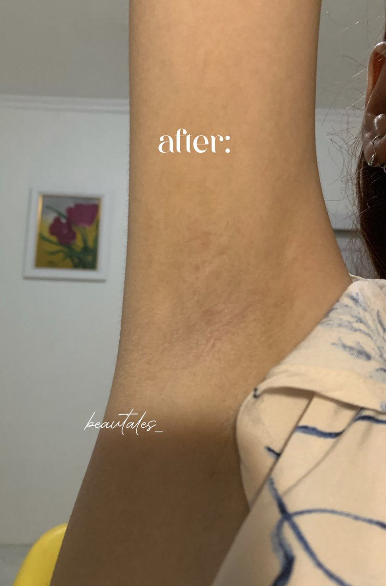 beautales_'s tweet photo. ⚠️ TW // KETIAK

*✰ setelah dua tahun rajin wax, aku ngerasa pertumbuhan bulu aku lebih lambat, ini bulu aku setelah ga waxing dua bulanan lebih padahal aku tergolong super hairy

heres a tutorial (+ tips) waxing buat beginner! ❤️ https://t.co/cXjsHNiPPg