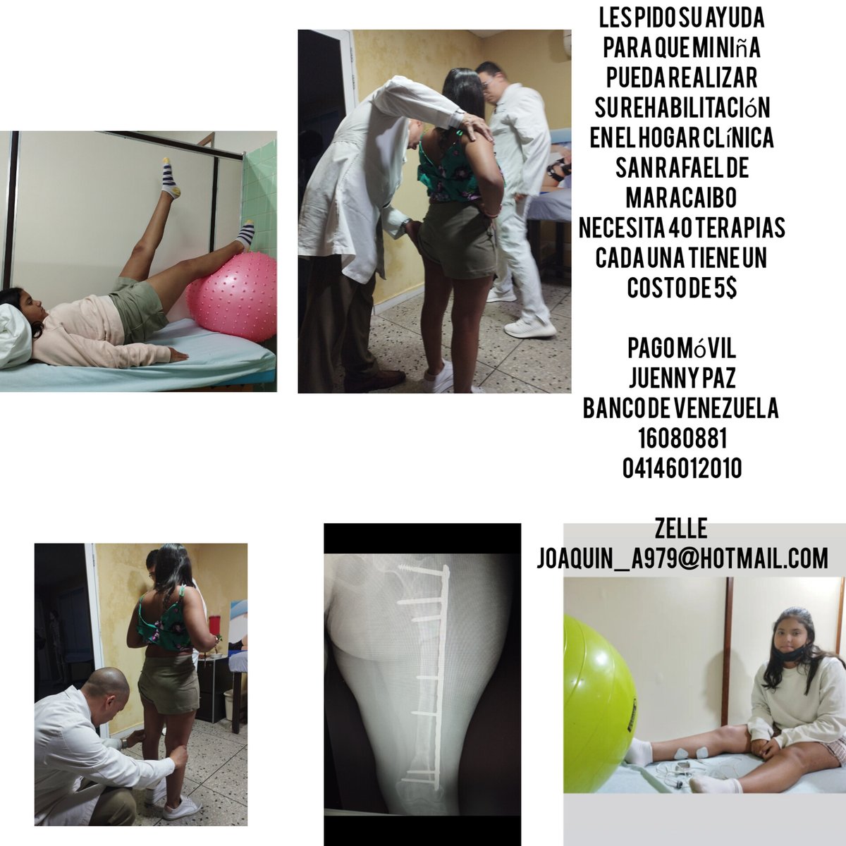 Mi hija es de Maracaibo ella se encuentra en proceso de rehabilitación en el Hogar Clínica San Rafael de Maracaibo luego de su tercera cirugía...quién pueda apoyarla a continuar con su proceso le agradecería infinitamente. Ella es sobreviviente de cancer de fémur.