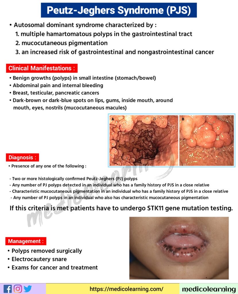 mendietaalex1's tweet photo. @drkeithsiau Peutz-Jeghers Syndrome
🌐is characterized by the association of gastrointestinal (GI) polyposis, mucocutaneous pigmentation, and cancer predisposition
🌐Hyperpigmented macules on the fingers are common
🌐Females are at risk for sex cord tumors, males May develop Sertoli cells t. https://t.co/1CUcdk0ceg