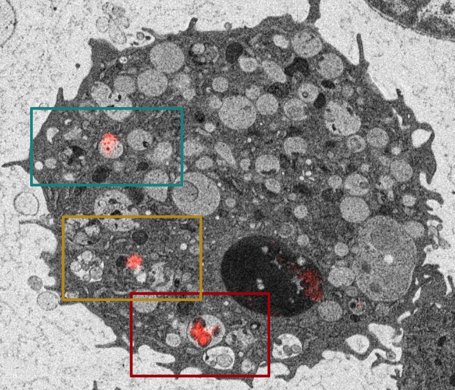 Si Ming Man (@simingman1) on Twitter photo βββ Check out our new paper published in <a href="/emboreports/">EMBO Reports</a> on the flesh-eating bacterium Clostridium perfringens lnkd.in/gA-x2i4A
Clostridium perfringens can cause food poisoning, and in some cases, very serious βflesh-eating diseaseβ called gas gangrene. π¦ π¬ 1/3 βββ Check out our new paper published in <a href="/emboreports/">EMBO Reports</a> on the flesh-eating bacterium Clostridium perfringens lnkd.in/gA-x2i4A
Clostridium perfringens can cause food poisoning, and in some cases, very serious βflesh-eating diseaseβ called gas gangrene. π¦ π¬ 1/3