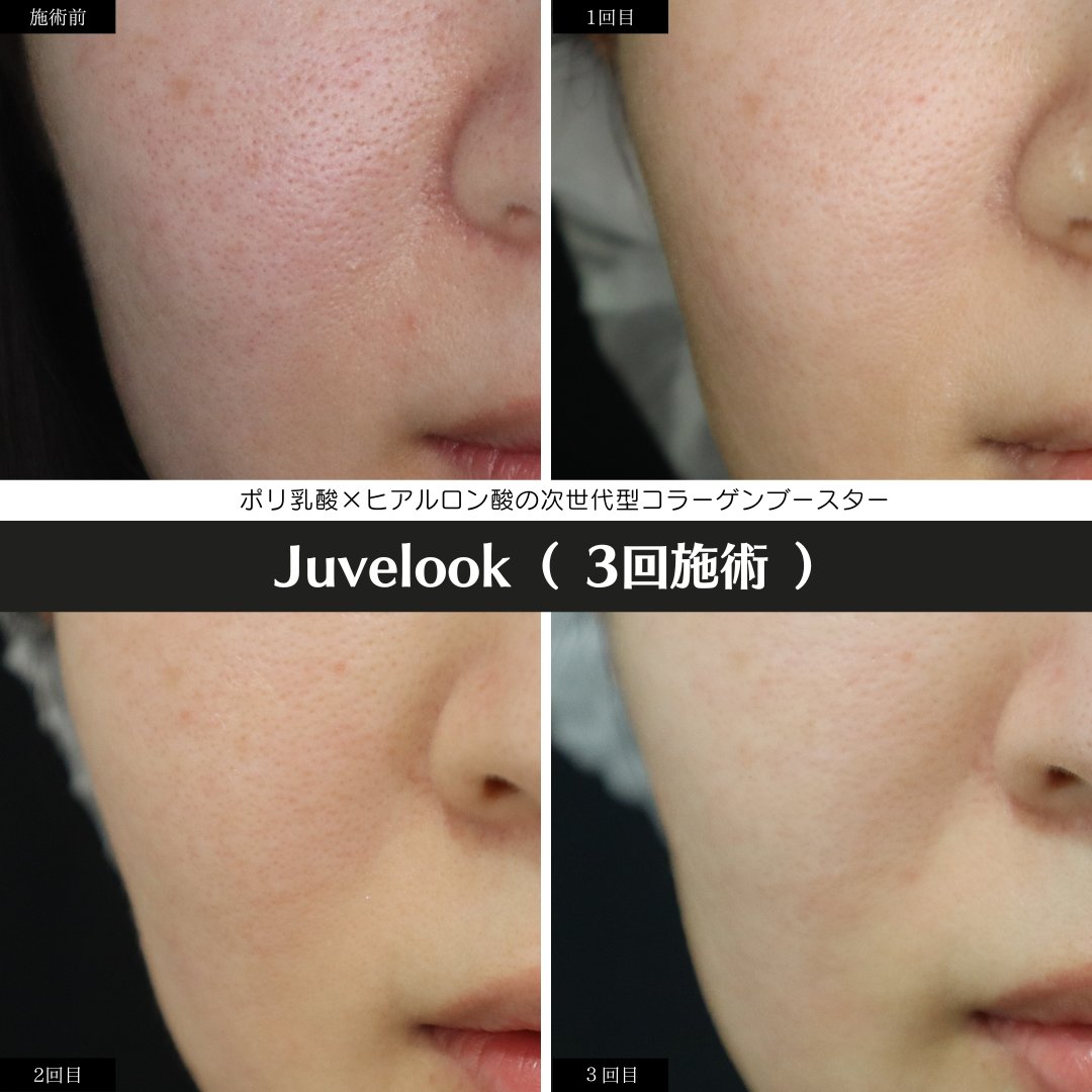 IdclinicG's tweet photo. 当院でジュベルック３回施術を終えたお客様の経過です📷
毛穴の開きが改善され、肌にハリがでたと満足して頂けました😊💕 https://t.co/0TQDXATBQ6