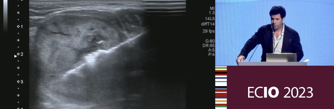 Eduardo Crespo (@dreduardocrespo) on Twitter photo An authentic pleasure to participate in the super congress #ECIO2023 and showcase how we treat benign #thyroidnodules through minimally invasive ablation <a href="/SERVEISoc/">SERVEI - Radiología Vascular Intervencionista</a> <a href="/Hospital_FJD/">Fundación Jiménez Díaz</a> <a href="/quironsalud/">quirónsalud</a> An authentic pleasure to participate in the super congress #ECIO2023 and showcase how we treat benign #thyroidnodules through minimally invasive ablation <a href="/SERVEISoc/">SERVEI - Radiología Vascular Intervencionista</a> <a href="/Hospital_FJD/">Fundación Jiménez Díaz</a> <a href="/quironsalud/">quirónsalud</a>